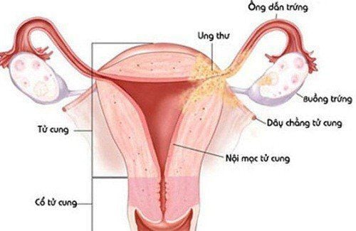 Viêm phần phụ có thể gây vô sinh