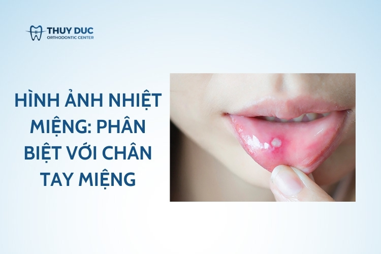 Hình ảnh nhiệt miệng: Phân biệt với các vết loét khác