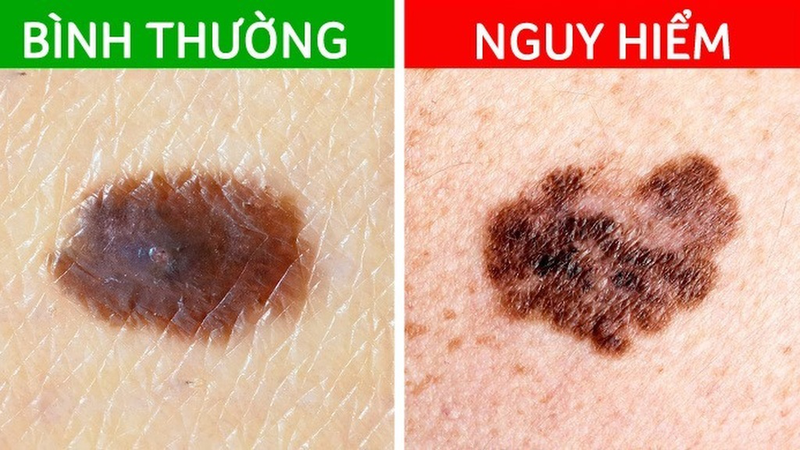 Nhận biết hình ảnh nốt ruồi ung thư: Dấu hiệu và phương pháp sàng lọc